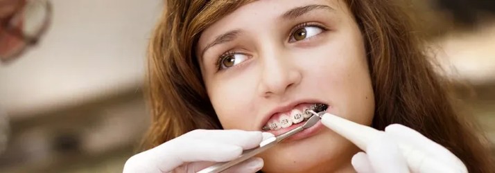 How to Brush Teeth With Braces in South Gate CA