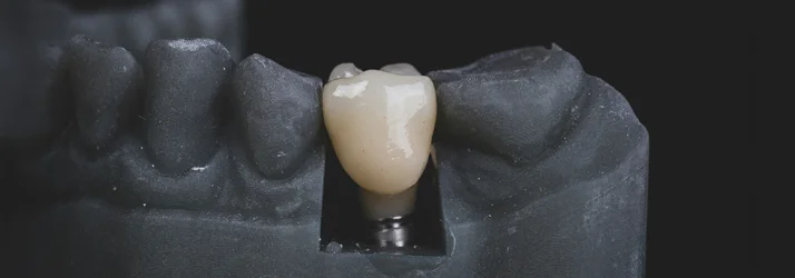 FC – Dental Implants at Embrace Dental and Orthodontics in South Gate CA