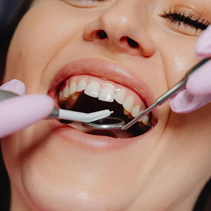A patient with their mouth open during a dental exam